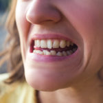 Surgically Facilitated Orthodontic Treatment (SFOT)