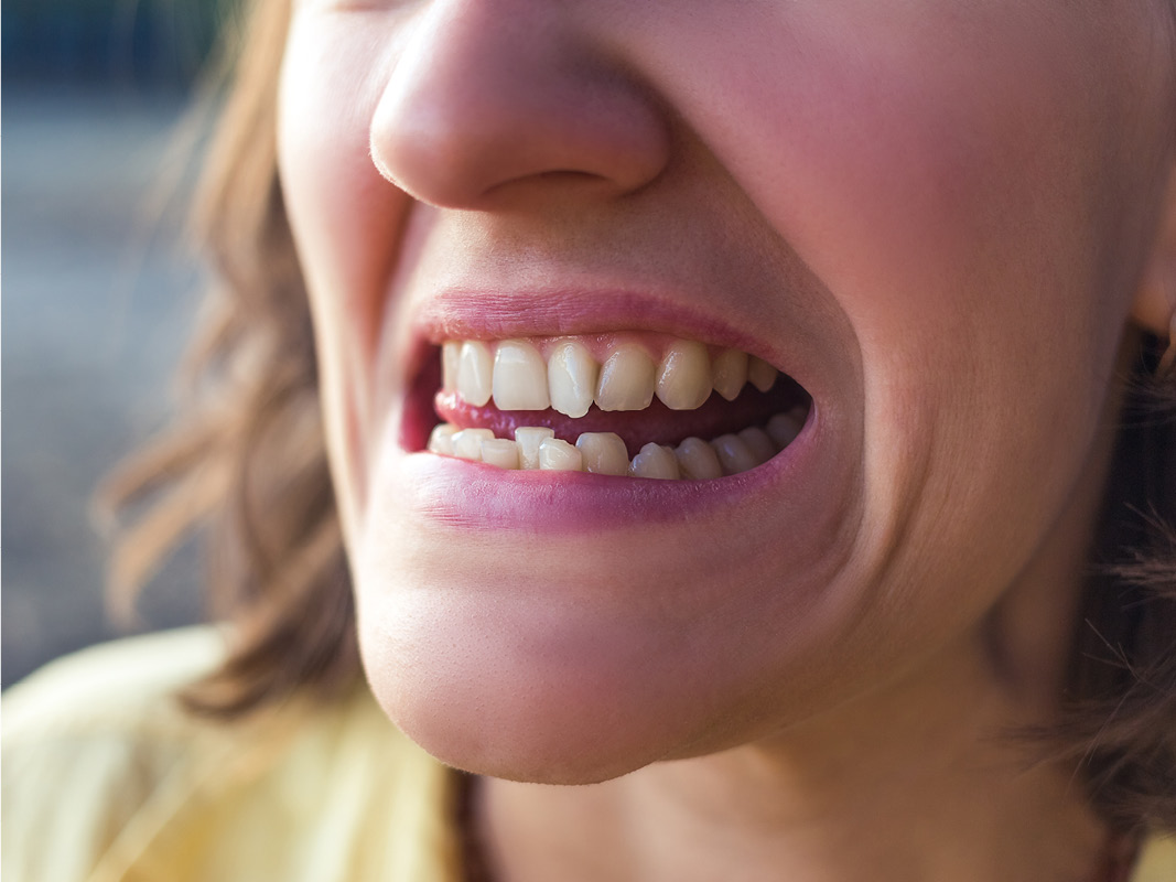 Close-up of woman's misaligned teeth