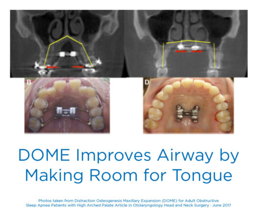 DOME for Sleep Apnea Improves Airway Making Room for Tongue