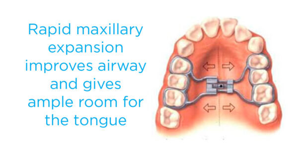 Rapid maxillary expansion  improves airway and gives  ample room for the tongue