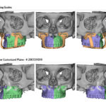 Surgical Planning for Maxillofacial Surgery