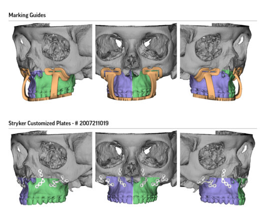 Surgical Planning for Maxillofacial Surgery