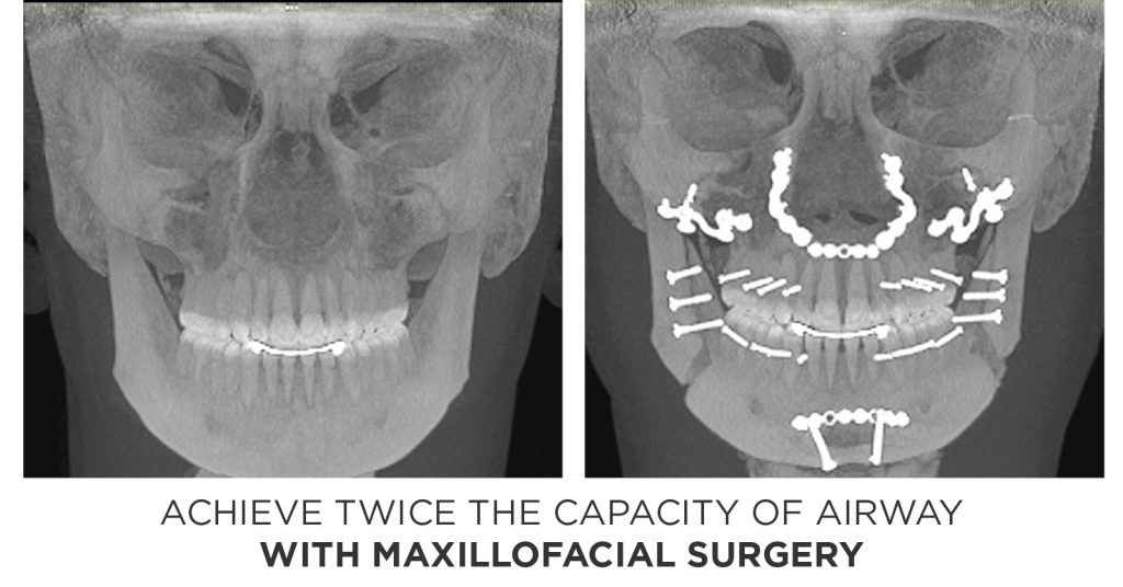 How Corrective Jaw Surgery Can Double the Size of Your Airway - Airway ...