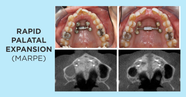 Non-surgical treatment of transverse deficiency in adults using Microimplant-assisted Rapid Palatal Expansion (MARPE) from the Dental Press Journal of Orthodontics