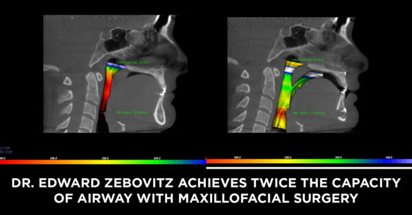 How Corrective Jaw Surgery Can Double the Size of Your Airway