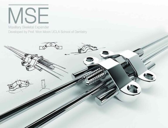 Achieve Maxillary and Mid-facial Parallel Expansion with the MSE