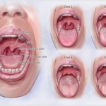 The Mallampati Score for Predicting Obstructive Sleep Apnea