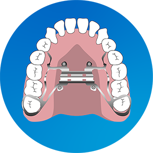 Distraction Osteogenesis Maxillary Expansion