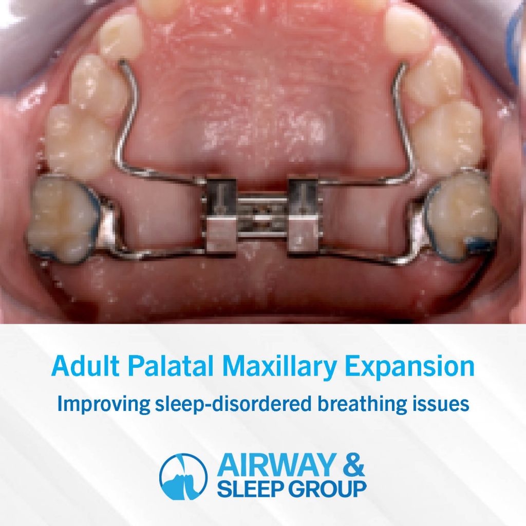 adult palatal maxillary expansion