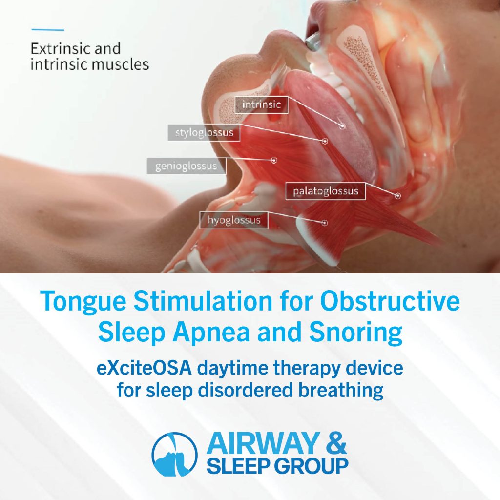Tongue stimulation for obstructive sleep apnea and snoring.